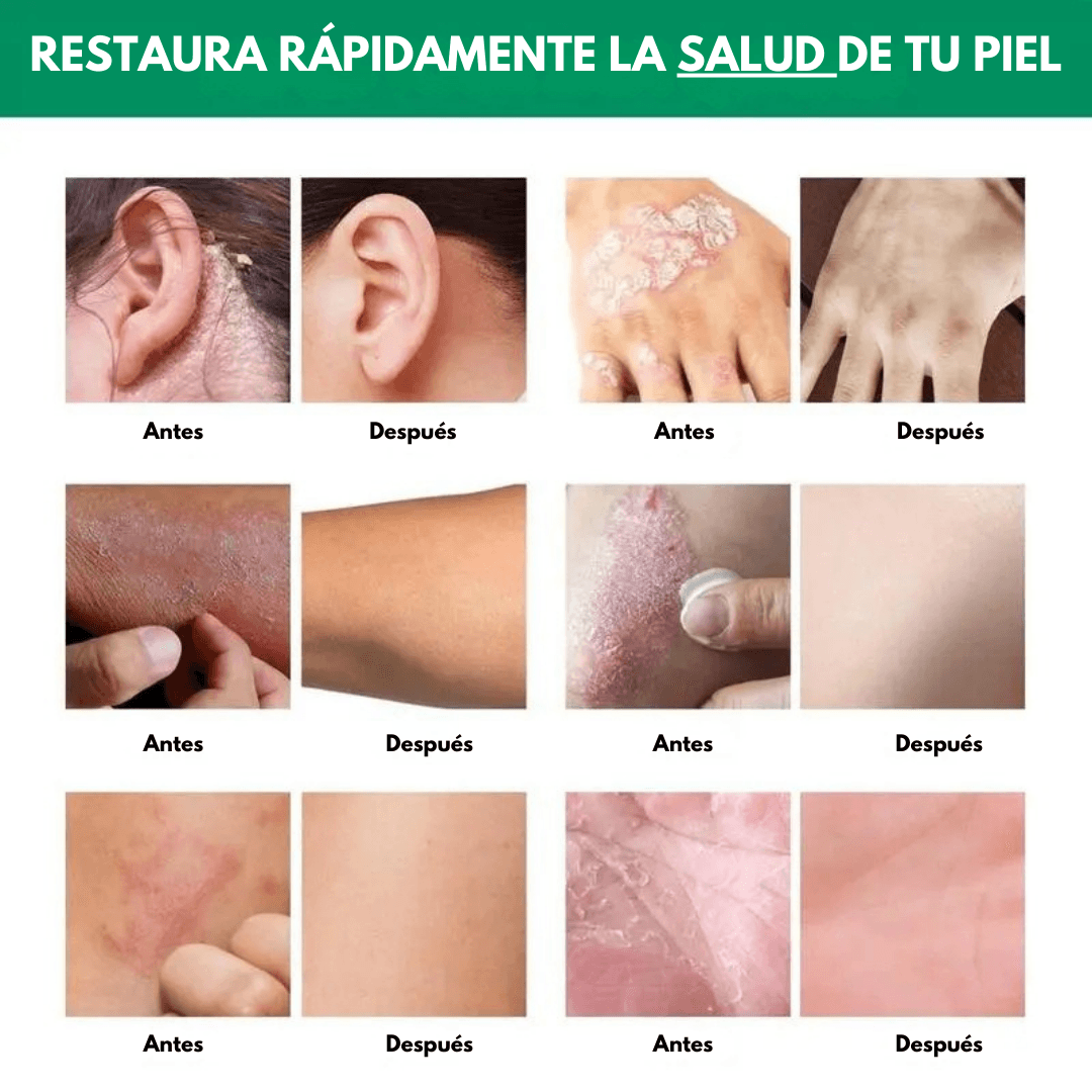 SeoulGlow® Tratamiento Anti Picores y Hidratante PRO – Fórmula 100% Natural - SeoulGlow