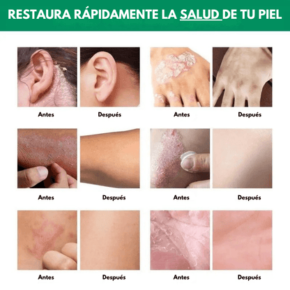 SeoulGlow® Tratamiento Anti Picores y Hidratante PRO – Fórmula 100% Natural - SeoulGlow